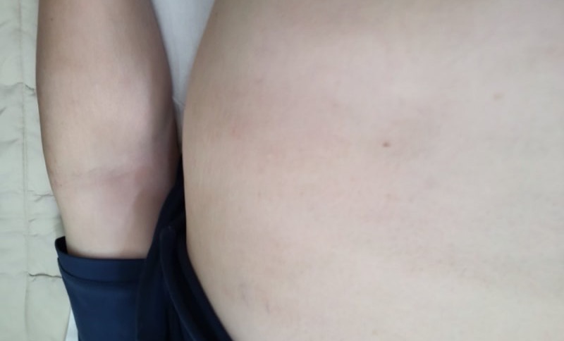 두드러기 해독탕 치료 2일 후 가라앉은 피부