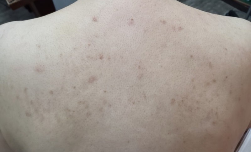 만성 피부 가려움 해독 치료 후 호전된 등 피부